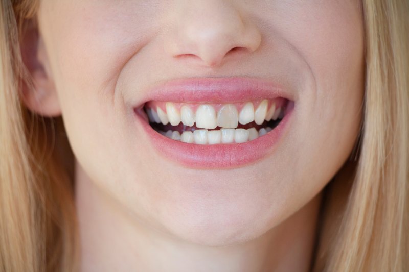 woman smiling with gray teeth in Aurora