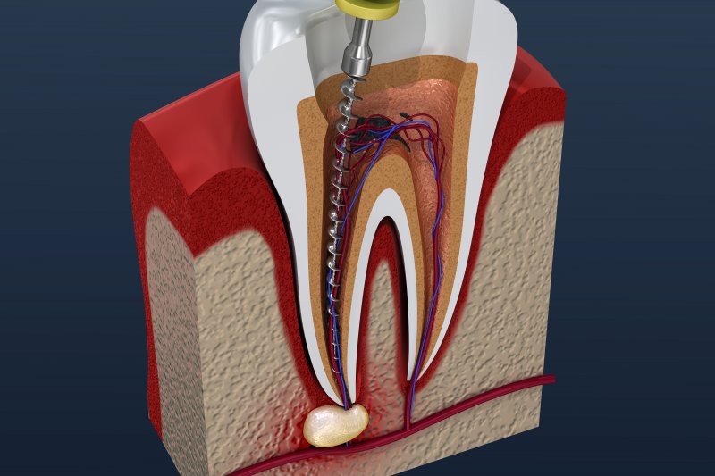 3-D Model of a root canal