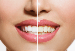 a before after photo demonstrating the effects of teeth whitening
