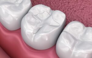 Dental filling. 