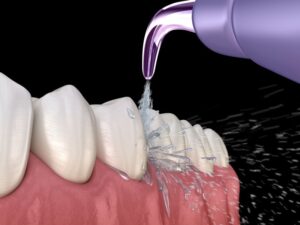 Illustration of water flosser cleaning between teeth 