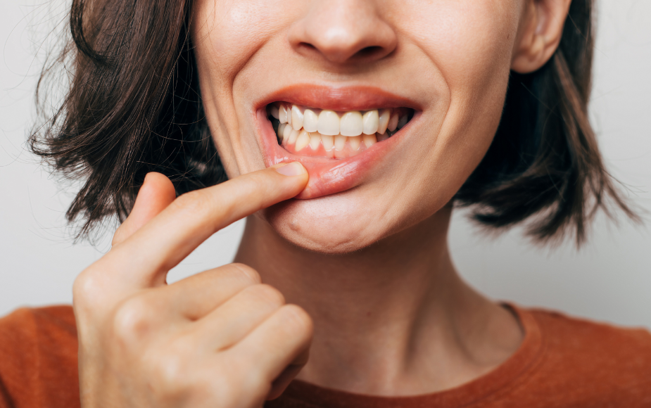 Woman with gum irritation